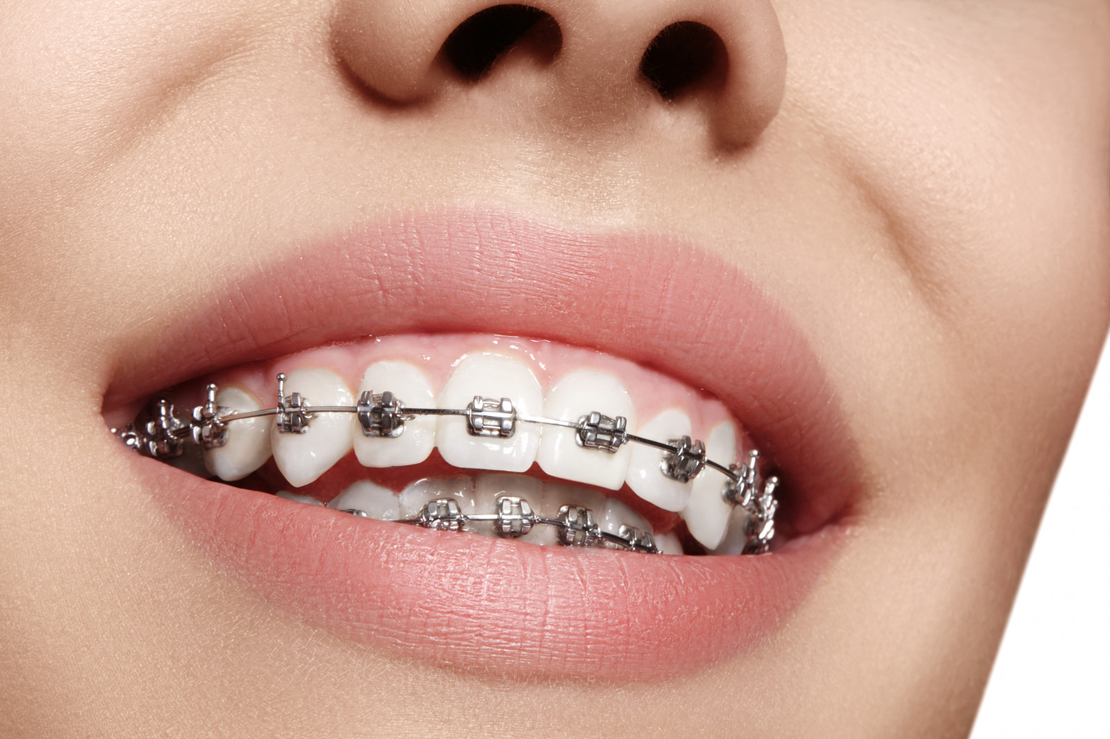 How Braces And Aligners Can Help You